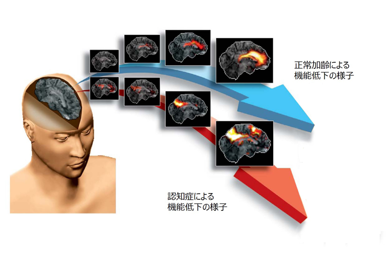 PET画像の変化からみる機能低下の概念図