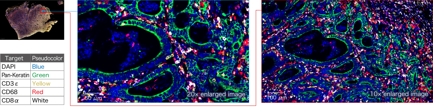 Image of Five-plex overlay image of paraffin-embedded human gastric cancer tissue