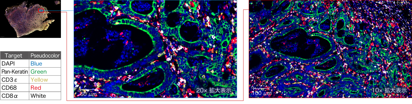 パラフィン包埋ヒト胃がん組織の5プレックス重ね合わせ画像