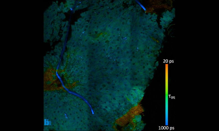 Confirmed liver tissue damage in the orange-colored area