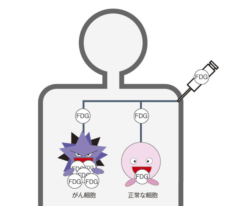 体内のFDGイメージ