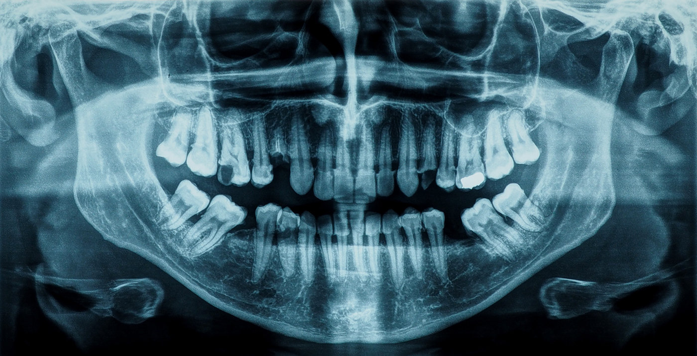 Example of panoramic dental x-ray image