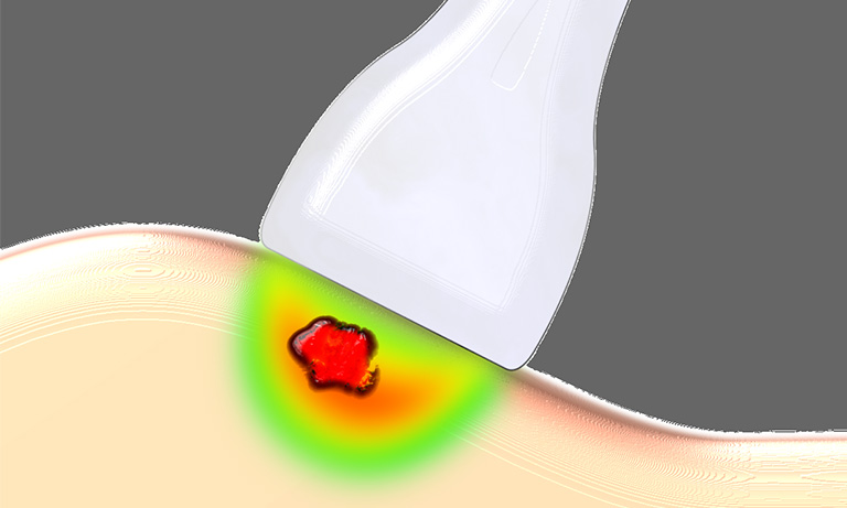 Optical mammography (Detecting and monitoring the breast cancer)