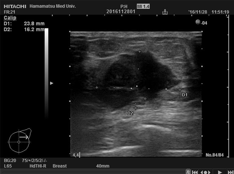 Ultrasonic image (3 weeks later)