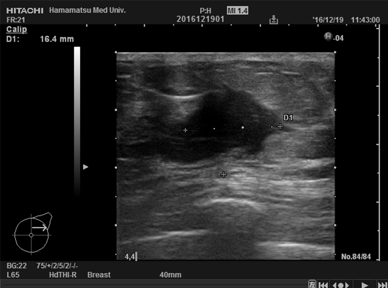 Ultrasonic image (6 weeks later)