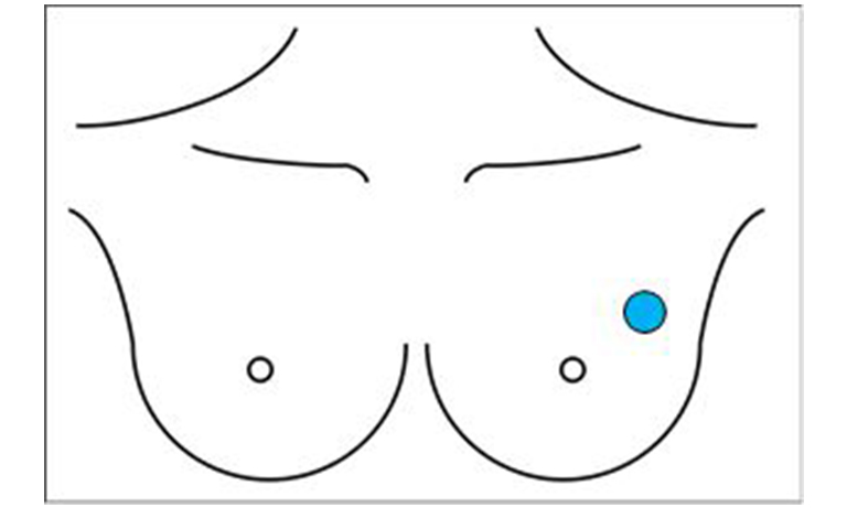 Location of tumor